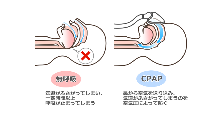図：持続陽圧呼吸療法（CPAP）